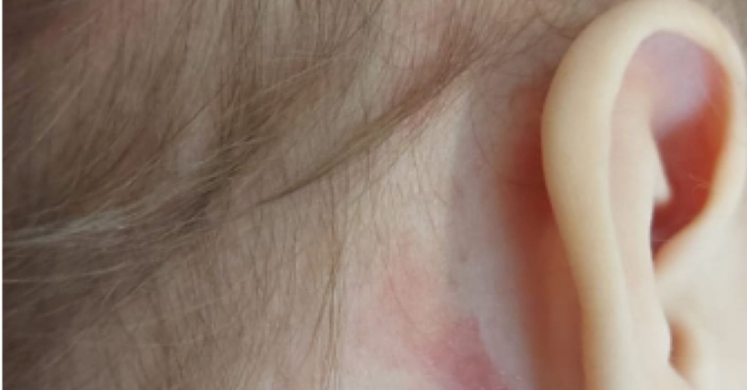 Histiocitose maligna: Criança com câncer raro precisa da sua ajuda