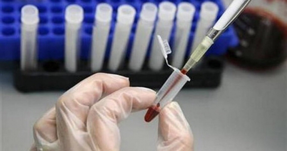 Governo brasileiro deixa contrato vencer e suspende exames de HIV e hepatites virais no SUS