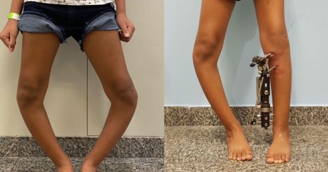 Técnica inovadora corrige deformidades nas pernas de crianças e jovens