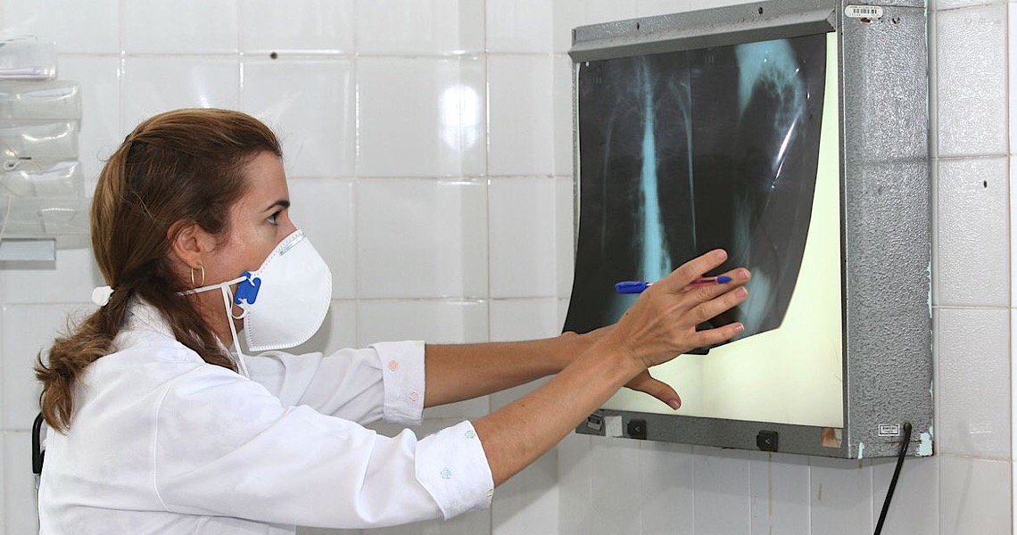 Pandemia reduz avanços no combate à tuberculose, diz especialista