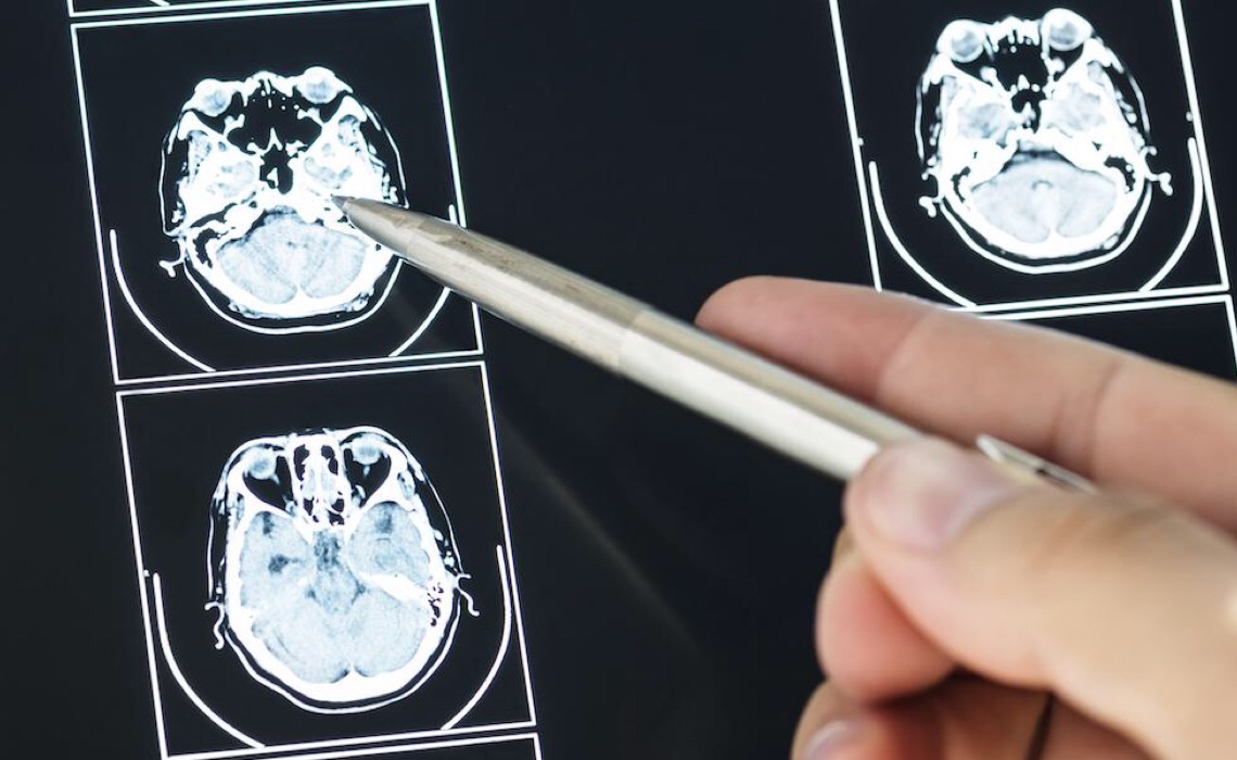 Esclerose múltipla afeta 35 mil brasileiros: especialista explica o que é a doença
