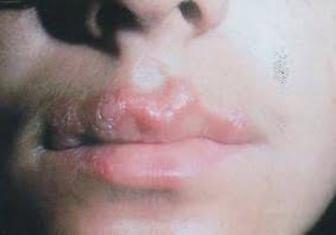 Doença viral: Saiba o que é herpes zoster?