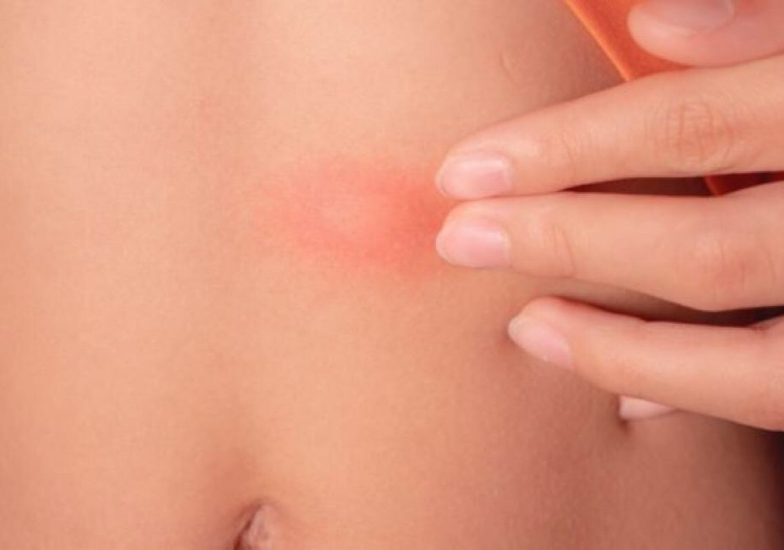 Ferroadas de insetos podem ser graves e causar anafilaxia