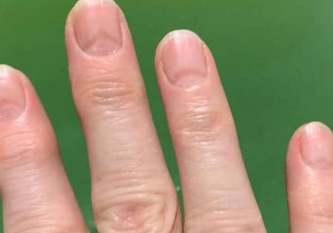 Alterações nas unhas podem indicar infecção pela covid-19