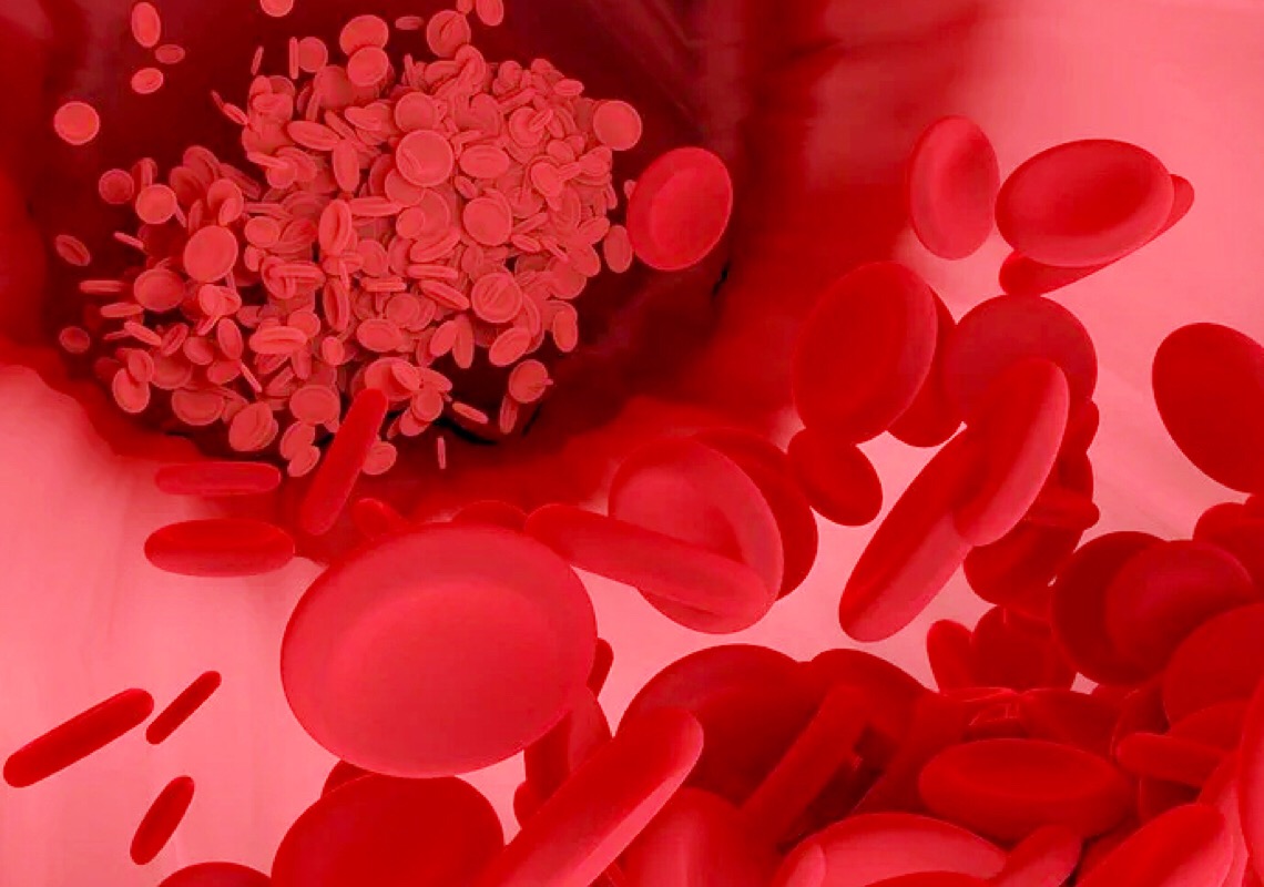Tromboembolismo pulmonar: Saiba o que é e quais os sinais preocupantes