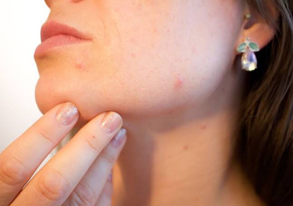 Pele oleosa: Duas dicas importantes para quem quer controlar a oleosidade
