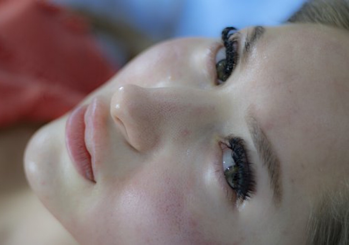 Dermatologista explica os principais cuidados com a pele oleosa a acneica durante o verão