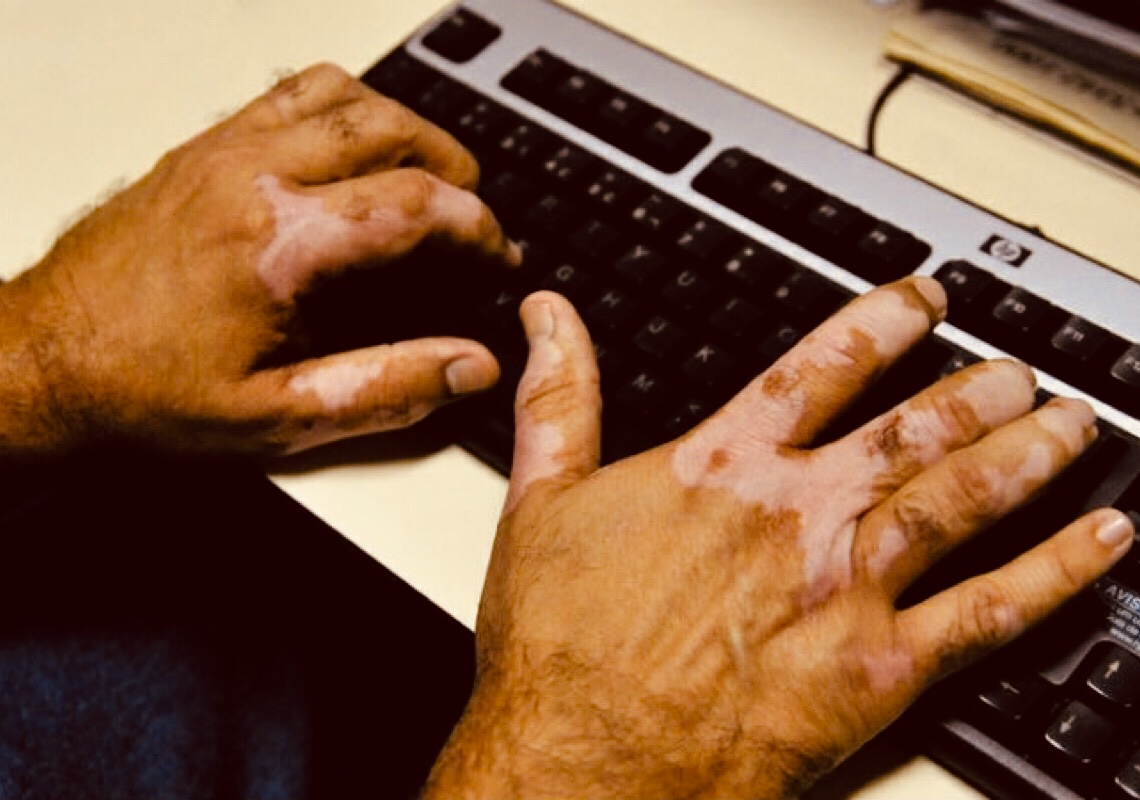 Paciente com vitiligo passa a ter novos direitos no DF