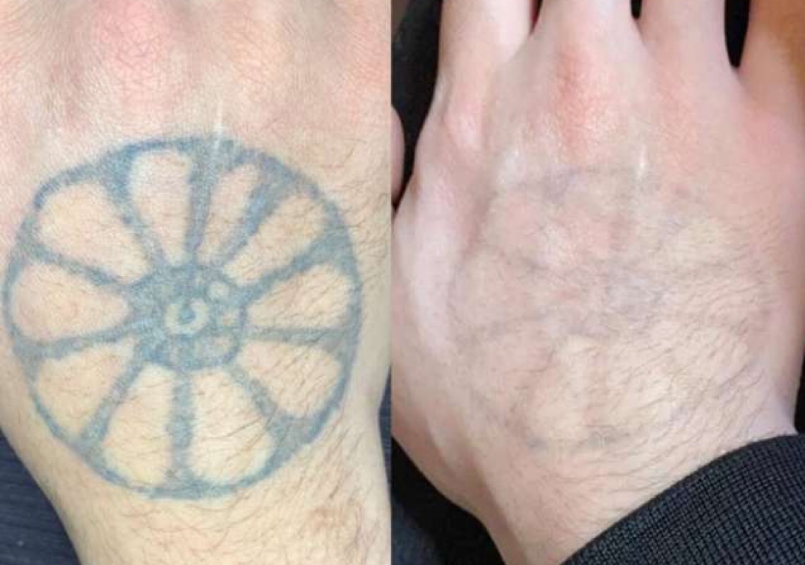 Especialista esclarece dúvidas sobre remoção de tatuagem
