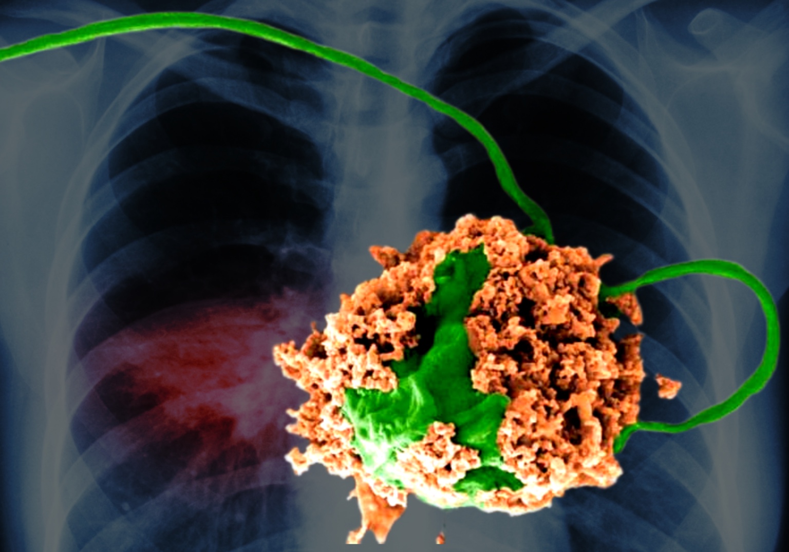 A nano robótica no tratamento da pneumonia