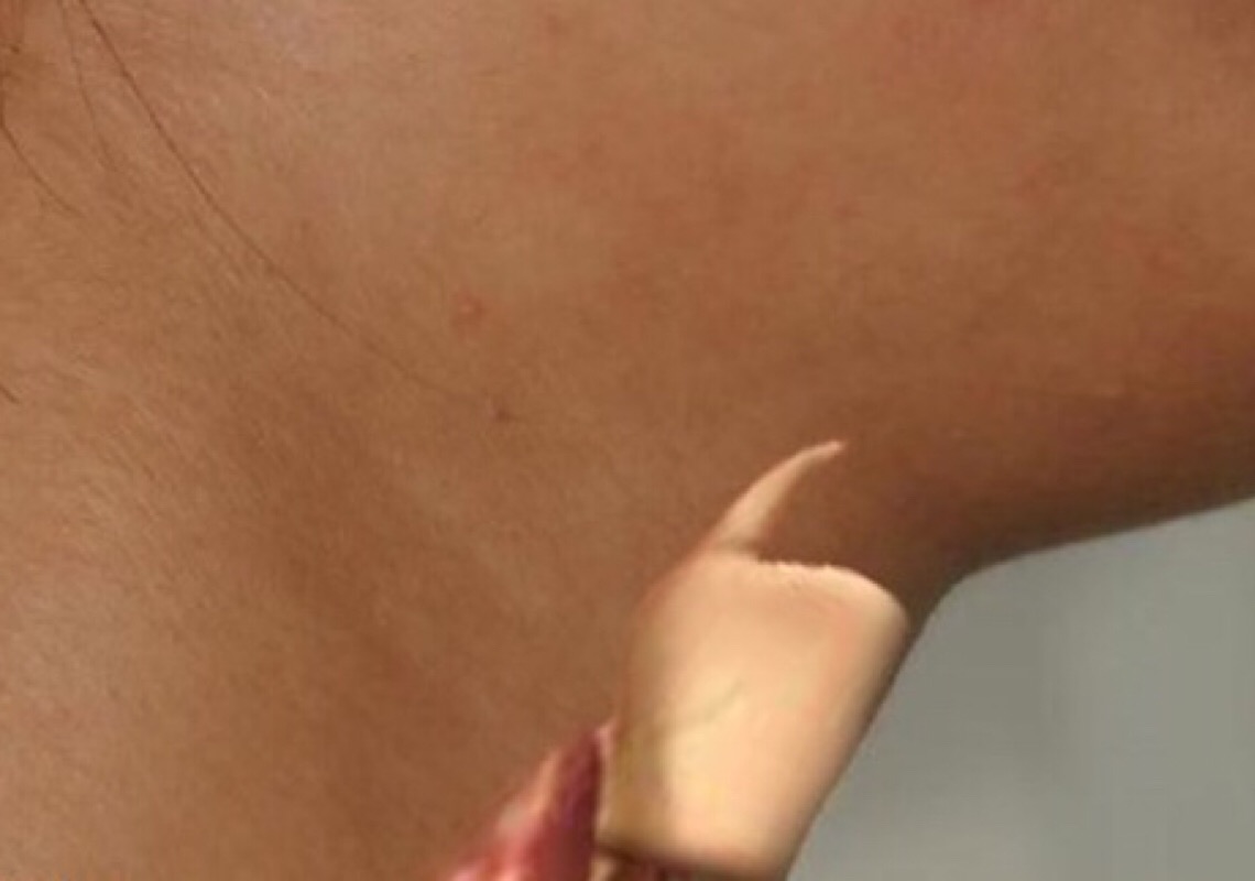 ANS inclui tratamento de câncer de tireoide na cobertura obrigatória