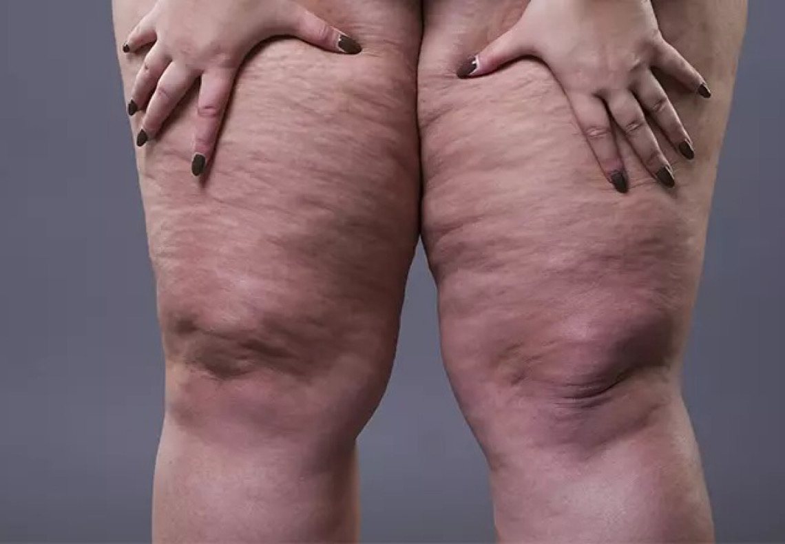 Lipedema: entenda como a doença atinge quase que exclusivamente mulheres