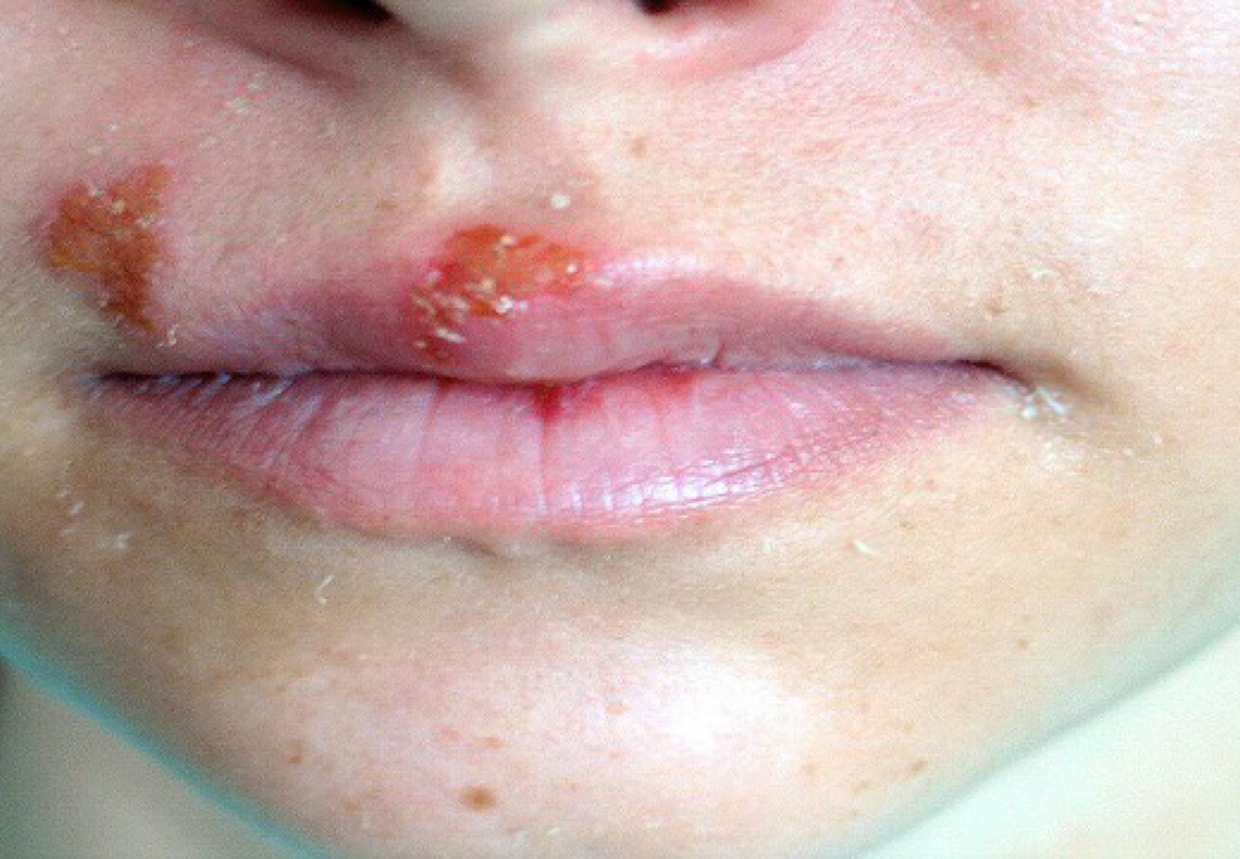 De herpes à surdez, saiba quais são os riscos do beijo