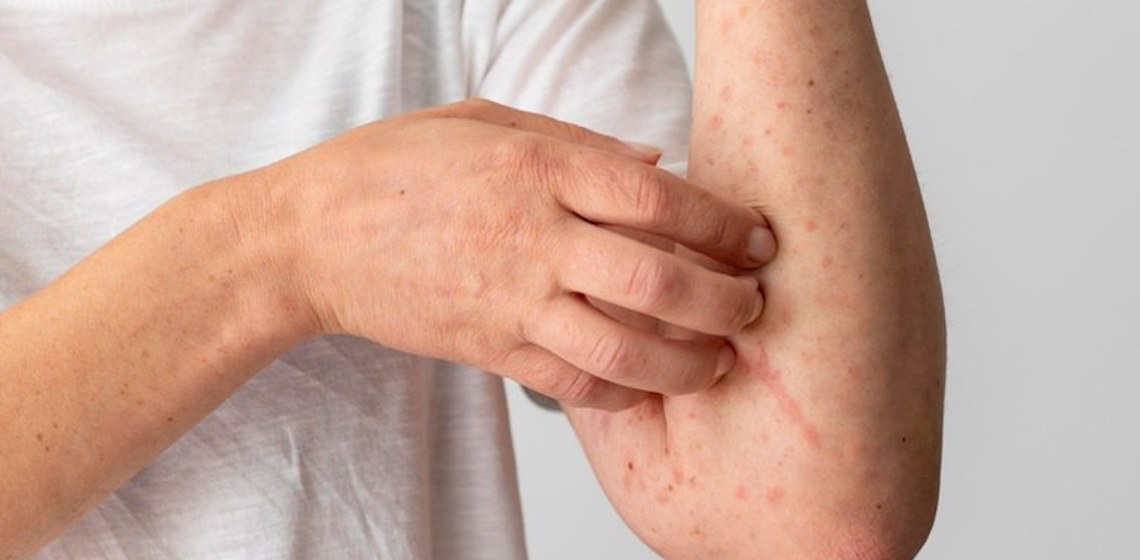 Alergia: saiba como se cuidar e os tratamentos oferecidos pelo SUS