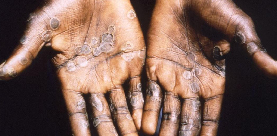 Mpox: O que você precisa saber sobre esta emergência global de saúde pública