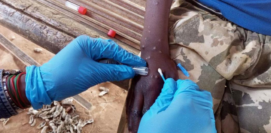 O acesso rápido a testes de diagnóstico é fundamental para combater a varíola dos macacos