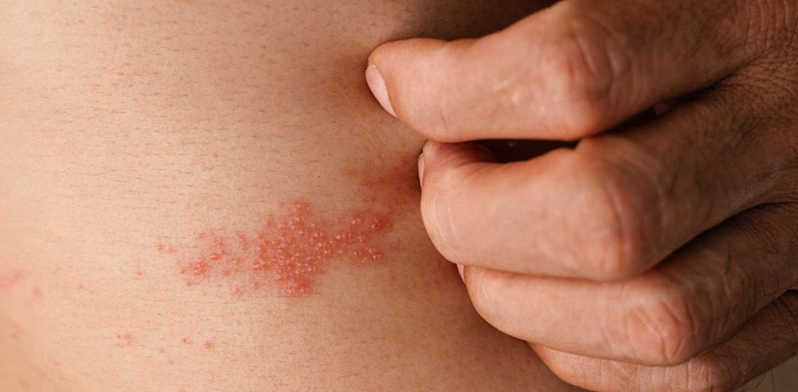 GSK lança campanha Vozes do Herpes Zoster. Ação conta com a participação de personalidades