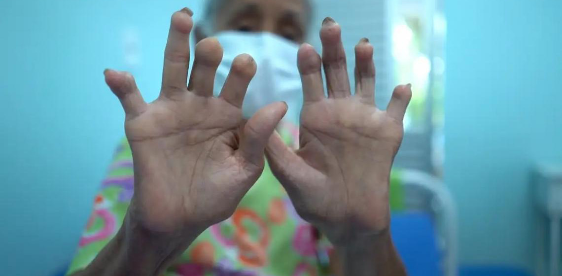 Ministério da Saúde e OMS reforçam parceria no enfrentamento à hanseníase