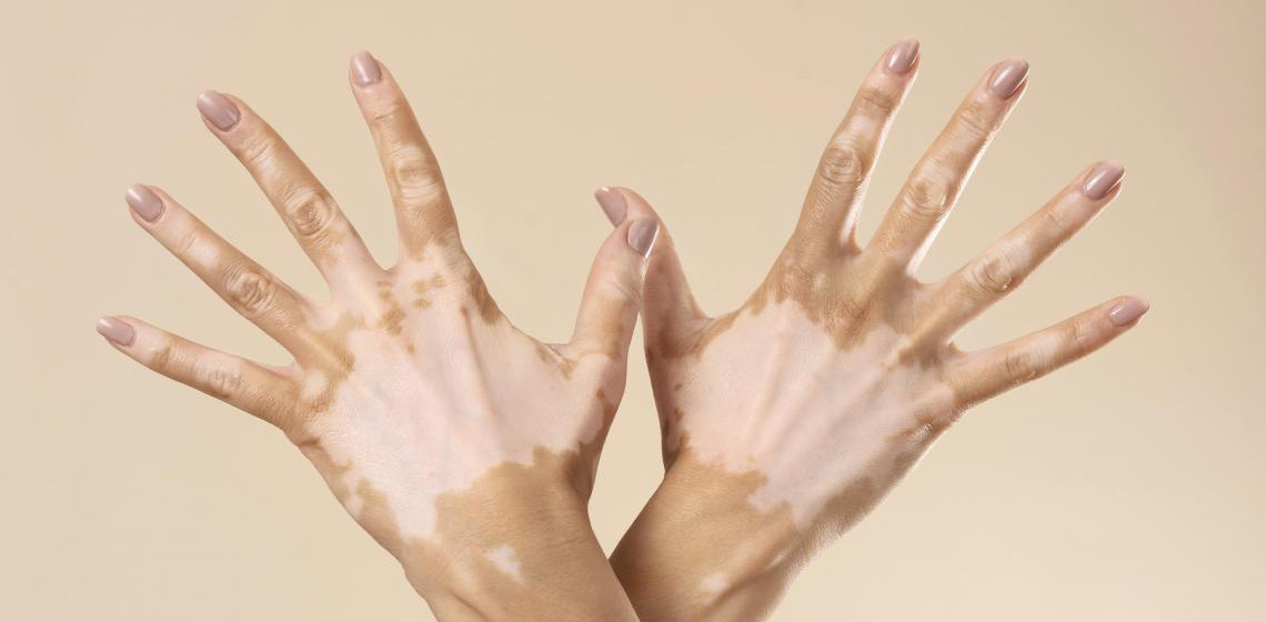 Dia Mundial do Vitiligo promove conscientização e combate o preconceito