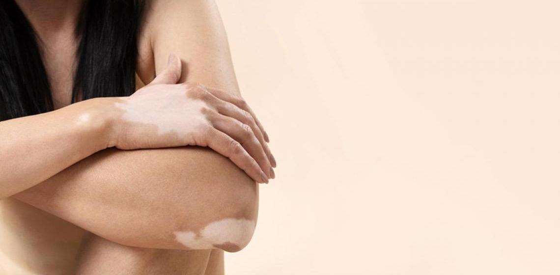 Oito estados oferecem fototerapia como tratamento para vitiligo no Brasil