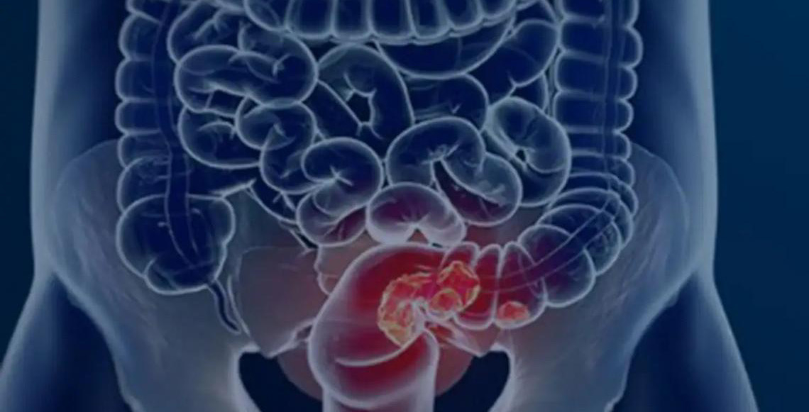 Pacientes com câncer colorretal são diagnosticados em estágio avançado