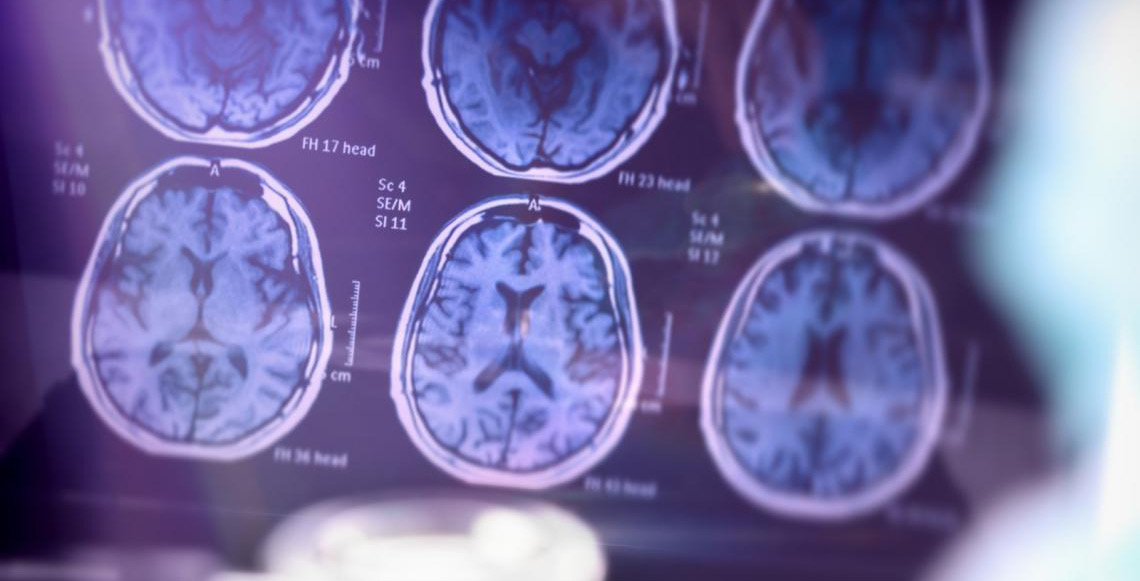 Diagnóstico precoce do Alzheimer ajuda pacientes e famílias a viverem com mais qualidade