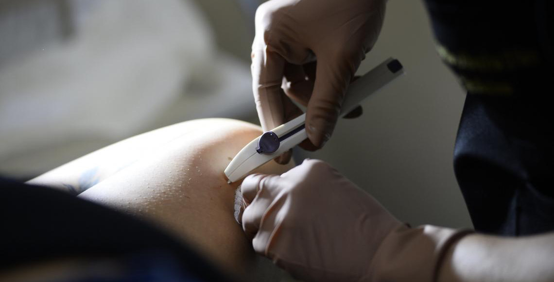 Novo método contraceptivo Implanon está disponível nas unidades básicas de saúde do DF