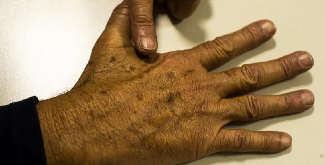 Desinformação sobre câncer de pele afeta diagnóstico, diz instituição