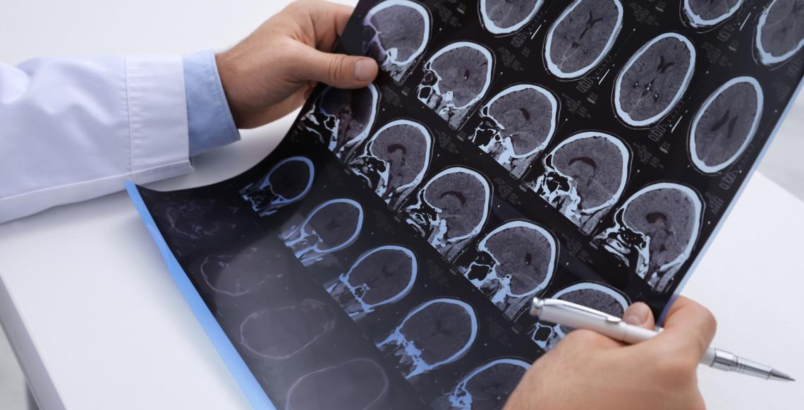 Esclerose múltipla é a principal causa de incapacidade neurológica em jovens adultos