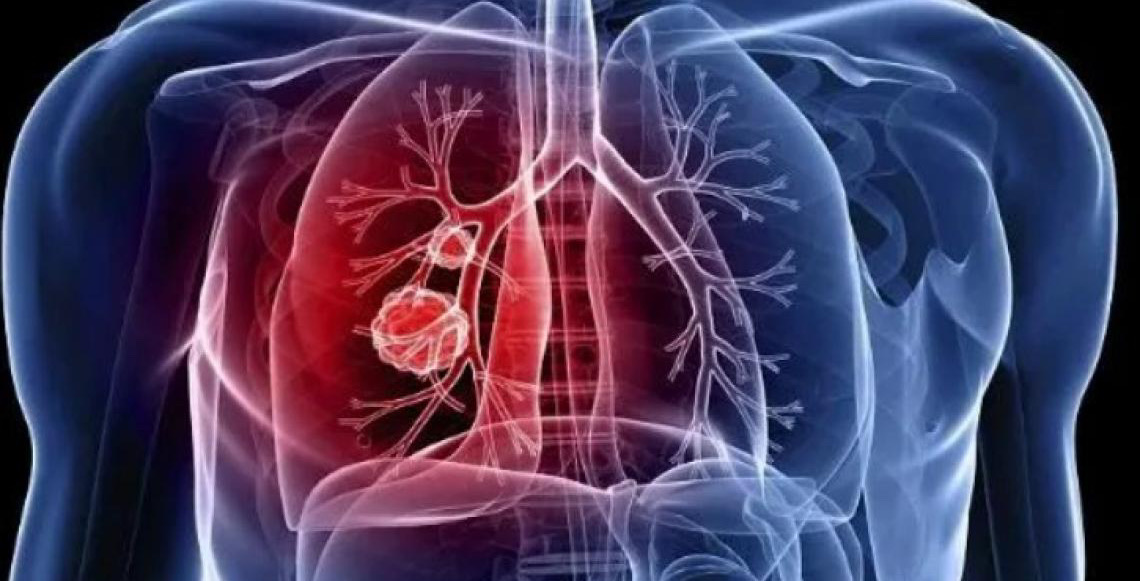 Comitê vai acompanhar encomenda tecnológica para teste portátil de tuberculose