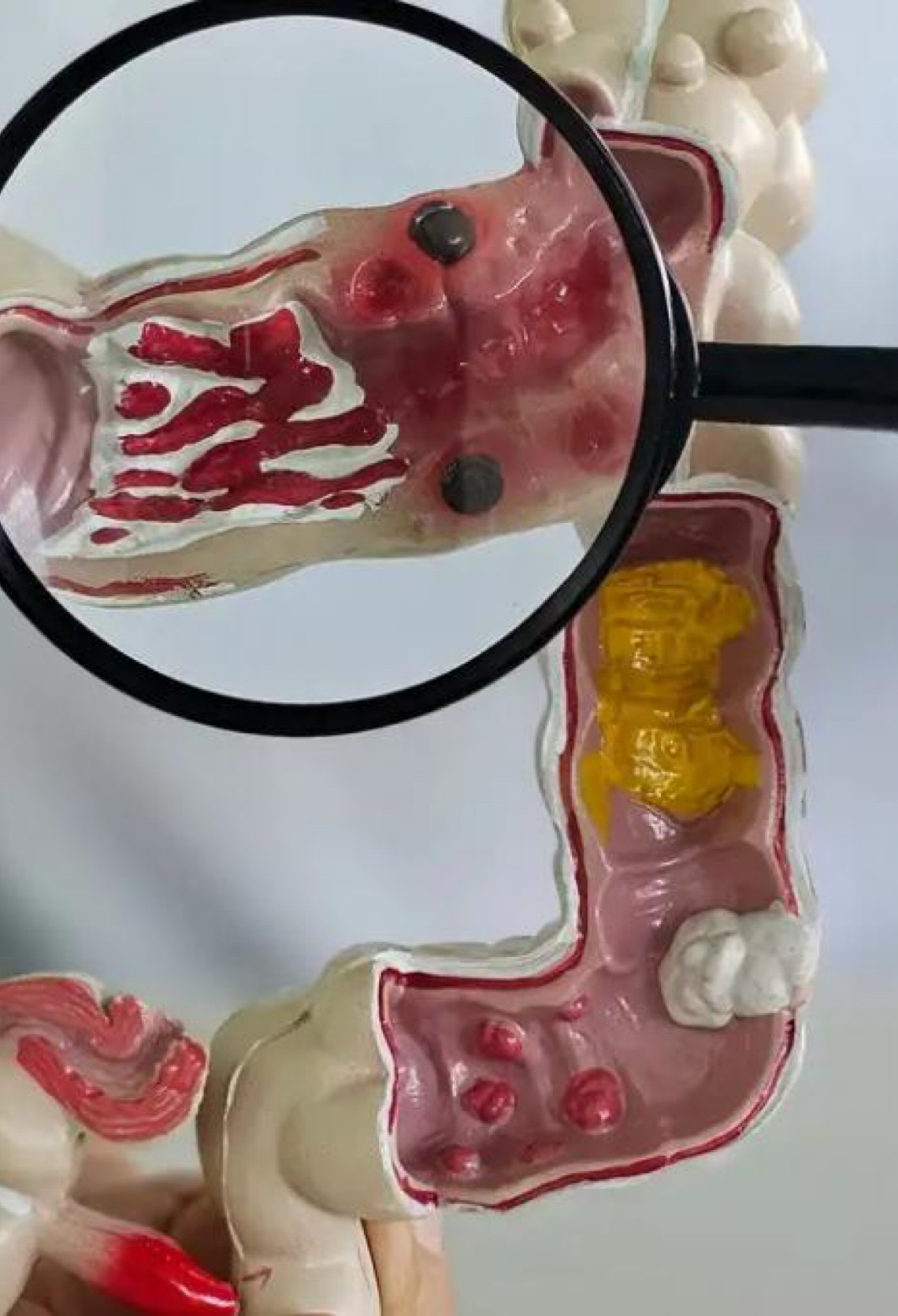 Em 13 anos, doença inflamatória intestinal cresce 5 vezes no Brasil, número de casos passou de 30 para 158