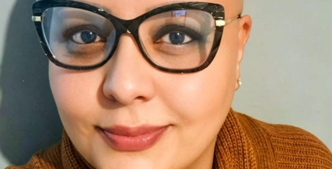 Pacientes com alopecia areata contam trajetória para reaver autoestima