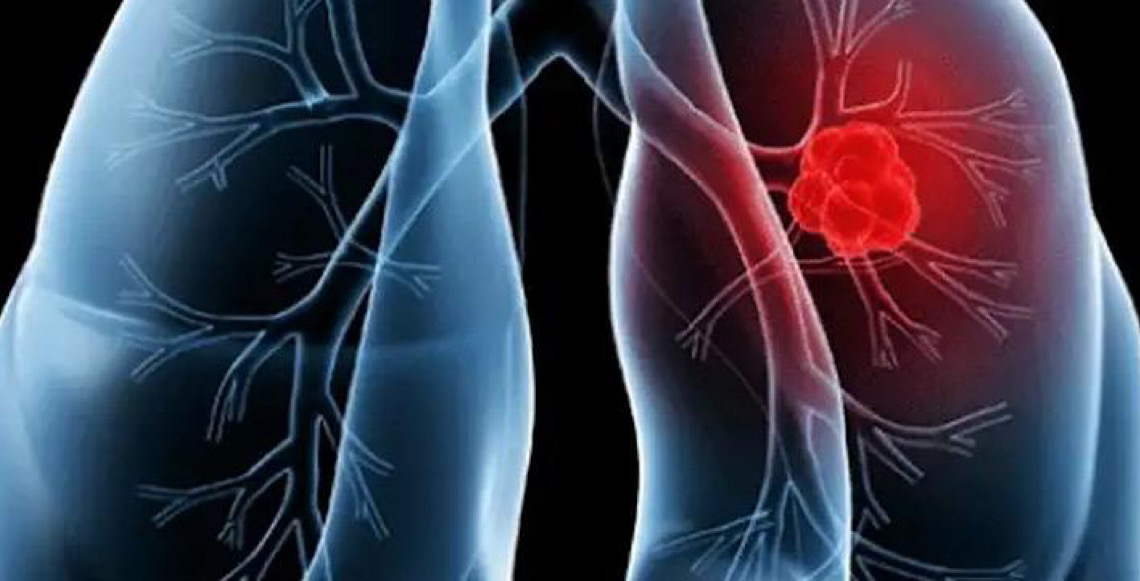 Saiba o que é adenocarcinoma pulmonar, que atinge o Papa Leão XIV