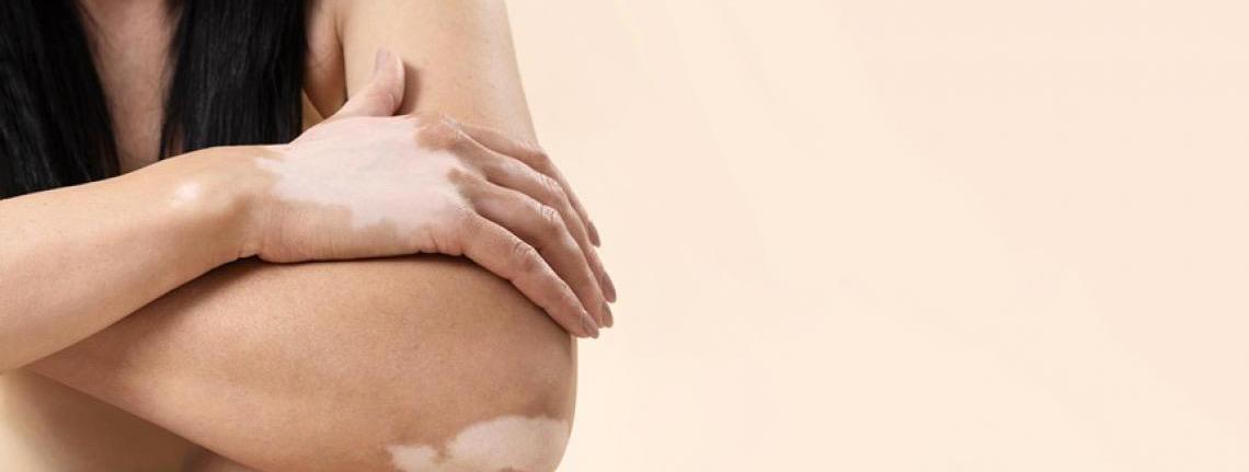 Oito estados oferecem fototerapia como tratamento para vitiligo no Brasil
