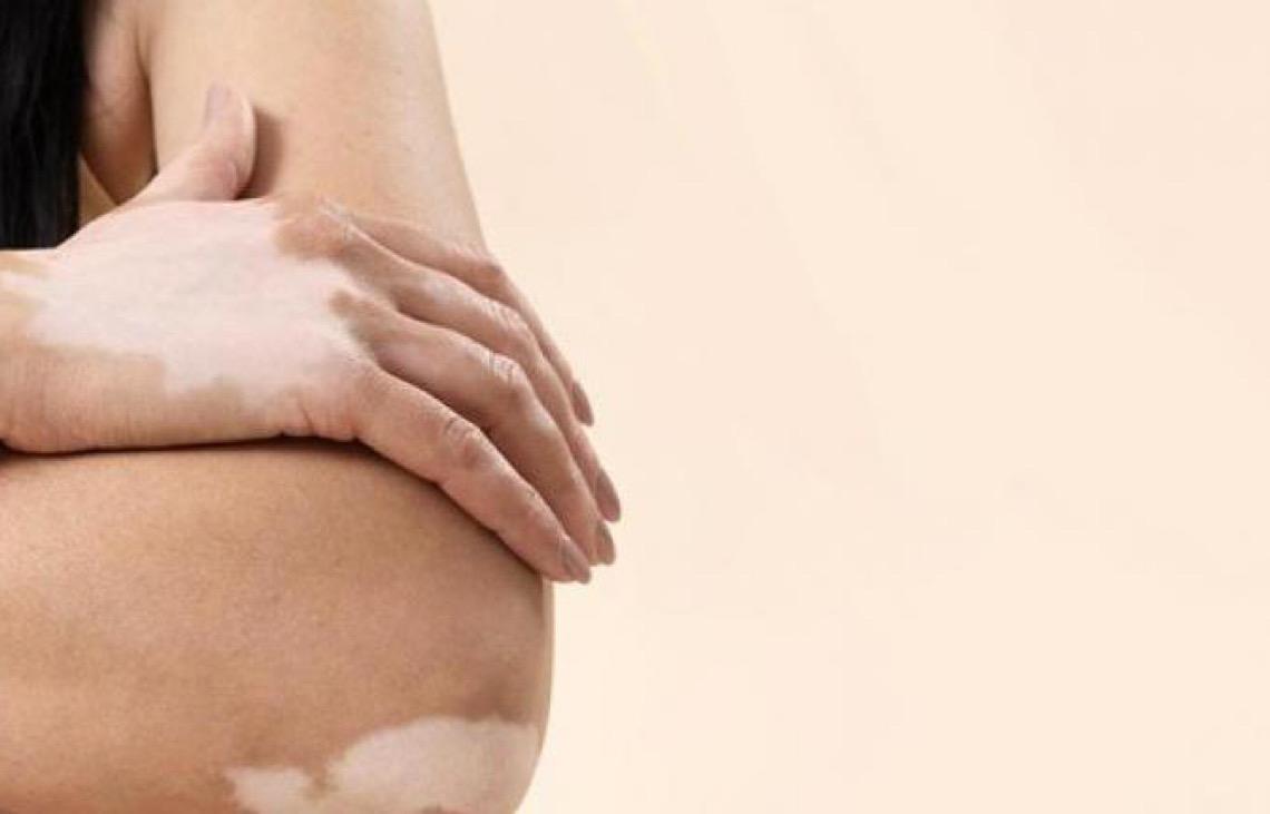 Oito estados oferecem fototerapia como tratamento para vitiligo no Brasil