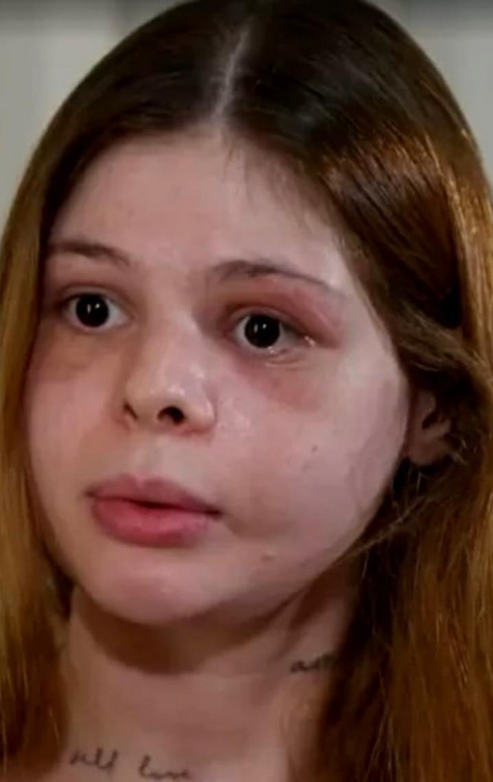 Médica agredida por ex-namorado fisiculturista ficou com rosto 'destruído'