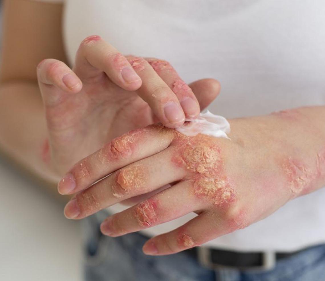 Dia Mundial da Psoríase: O desafio de cuidar da pele e das emoções