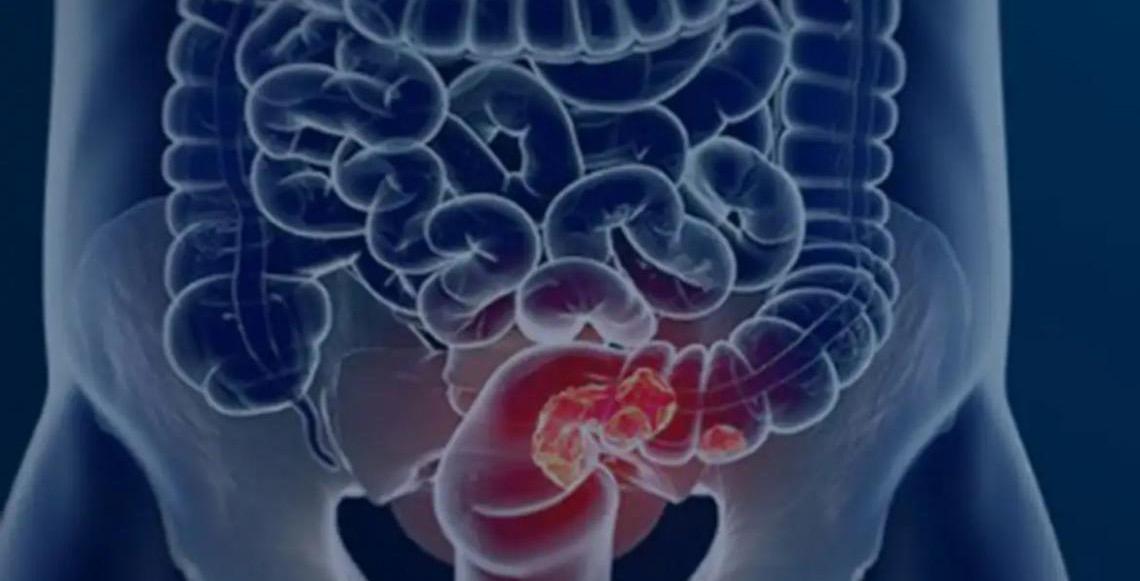 Pacientes com câncer colorretal são diagnosticados em estágio avançado