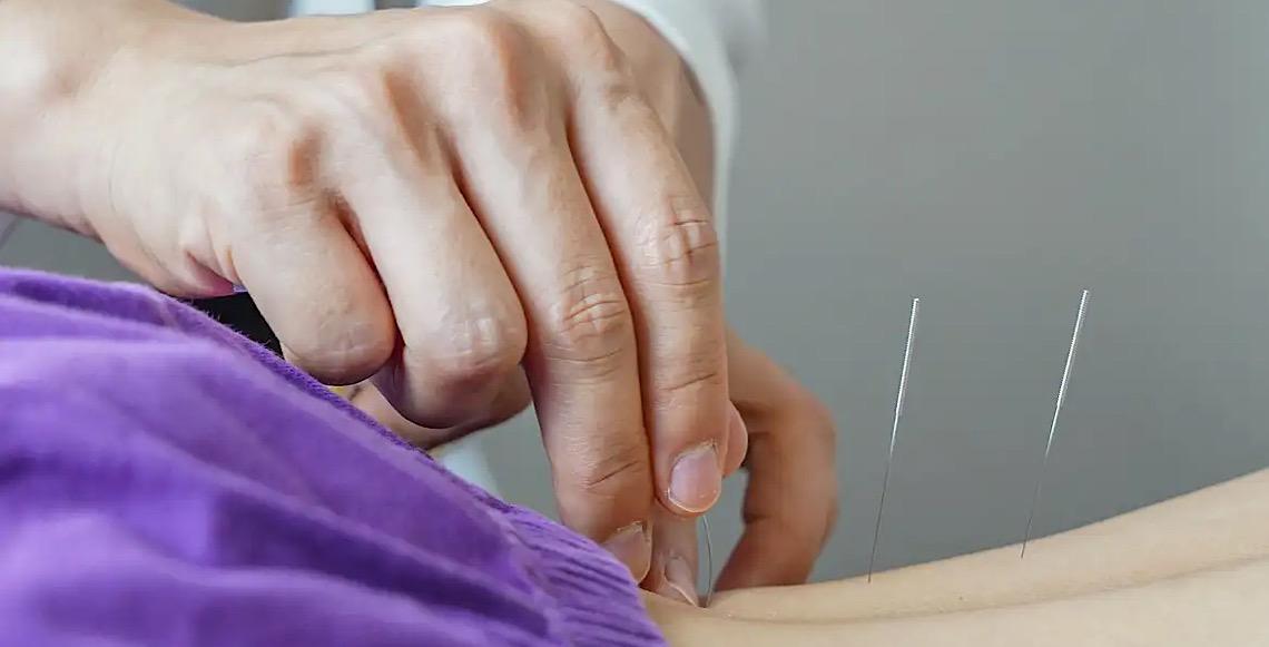 Brasil regulamenta exercício profissional da acupuntura