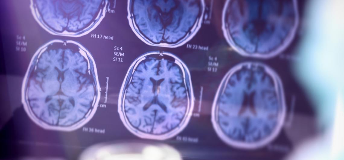 Diagnóstico precoce do Alzheimer ajuda pacientes e famílias a viverem com mais qualidade