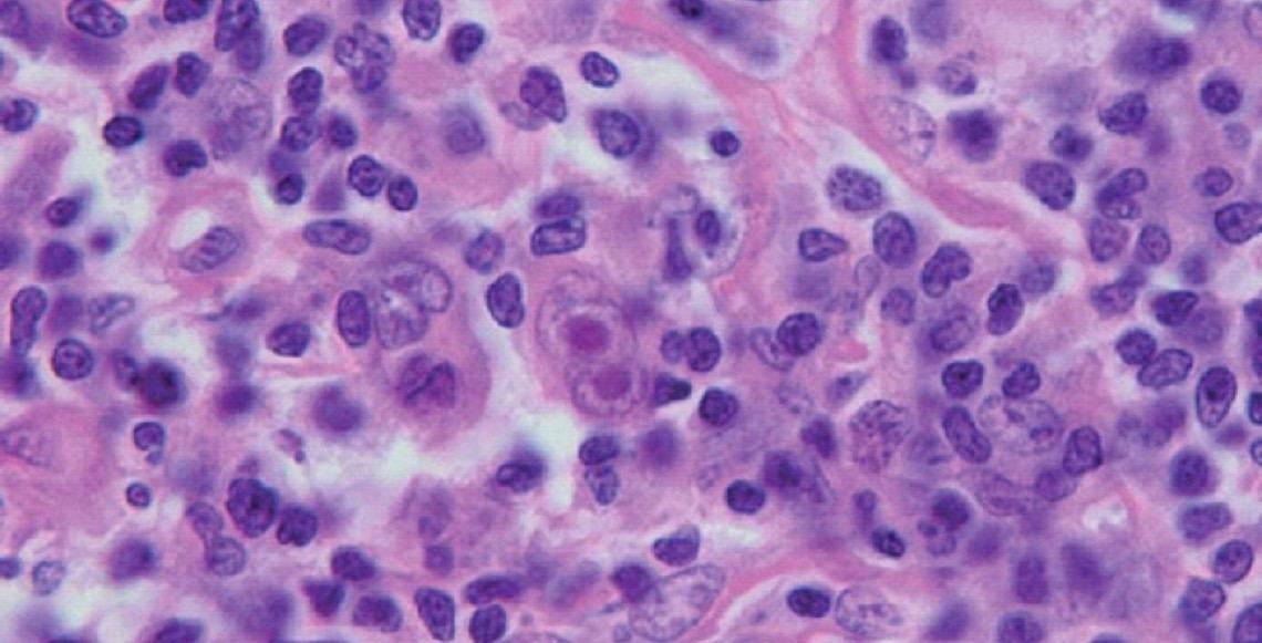 Agência Nacional de Vigilância Sanitária aprova novo medicamento para linfoma de Hodgkin clássico