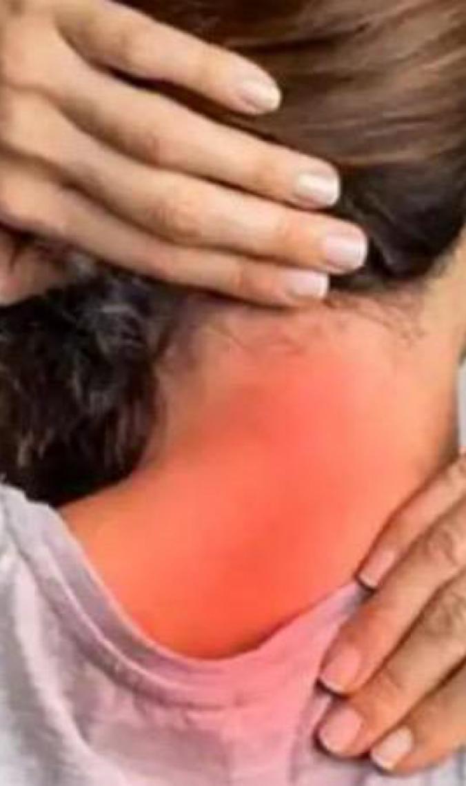 Câncer de cabeça e pescoço é o terceiro mais comum no Brasil