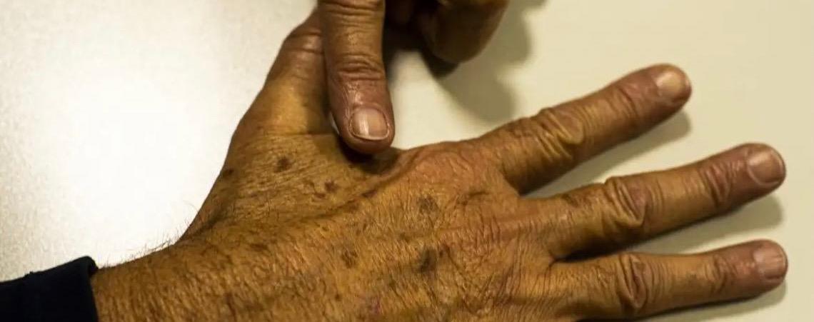 Desinformação sobre câncer de pele afeta diagnóstico, diz instituição