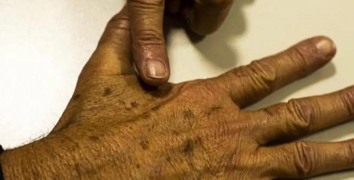 Desinformação sobre câncer de pele afeta diagnóstico precoce e o tratamento da doença, diz instituição