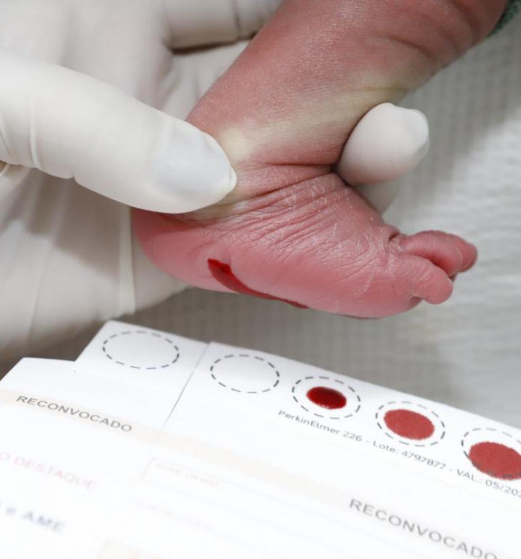 Distrito Federal é pioneiro no diagnóstico precoce da doença de Fabry pelo teste do pezinho