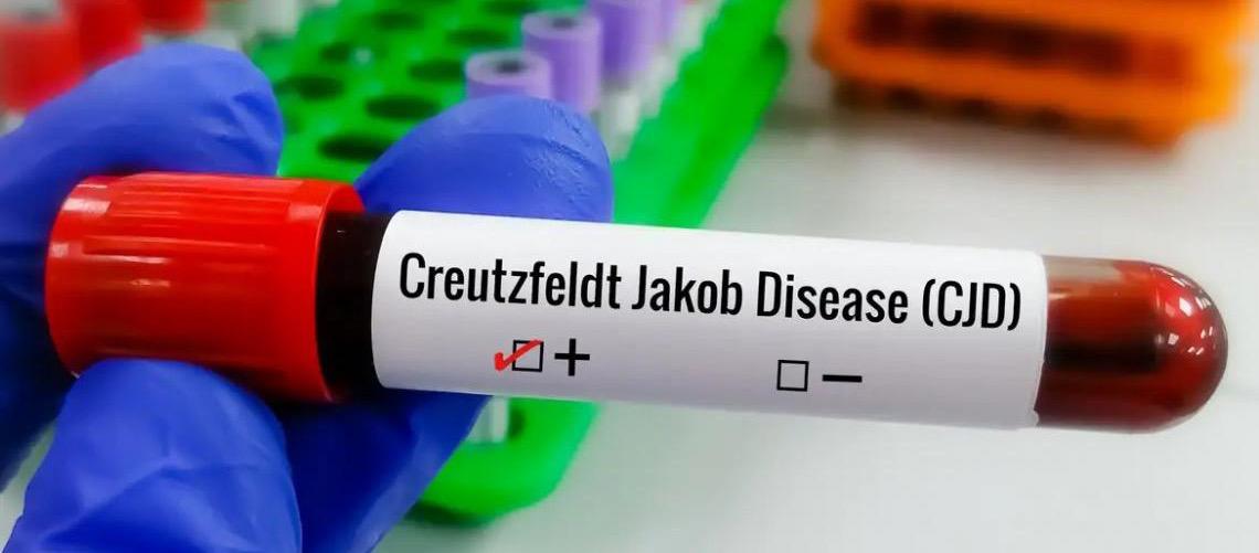 Entenda Doença de Creutzfeldt-Jakob, diagnóstico do piloto e youtuber Lito Souza